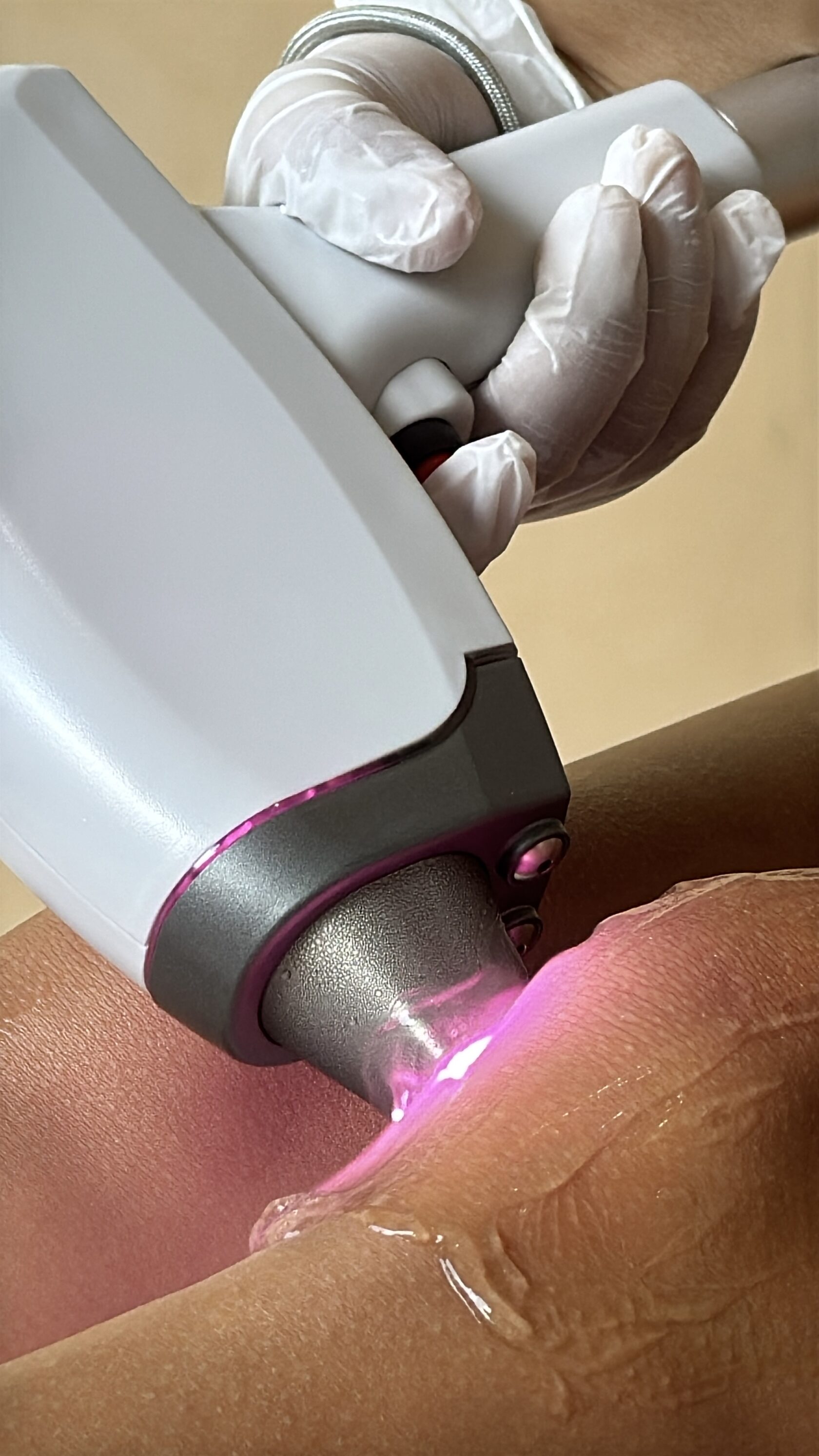 Laser hair removal